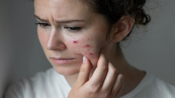 كيف يمكن للبثور في الوجه أن تهدد حياتك؟